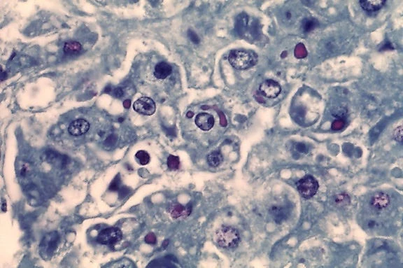 The first cancer vaccine