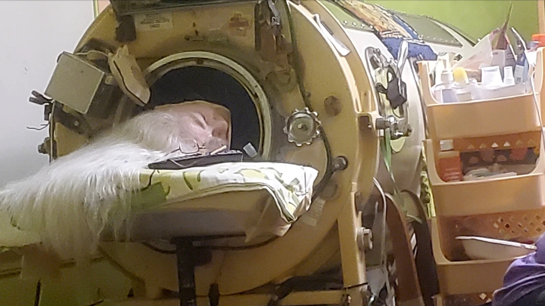 Martha Lillard, last US polio patient using iron lung, dies at 78 in Oklahoma