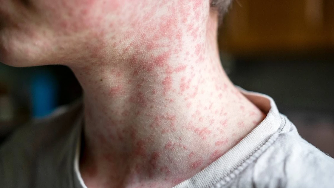 Measles surge in Utah sparks fears US could undo decades of progress