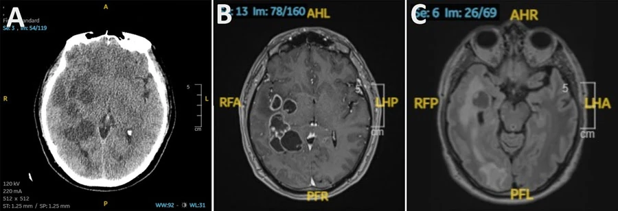 Doctors suspected man had brain cancer. He had worms
